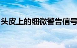 头皮上的细微警告信号可能预示着帕金森氏症