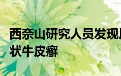 西奈山研究人员发现局部治疗可改善慢性斑块状牛皮癣