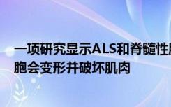 一项研究显示ALS和脊髓性肌萎缩症模型中愈合的间充质细胞会变形并破坏肌肉