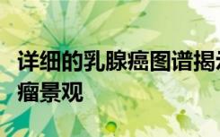 详细的乳腺癌图谱揭示了遗传变化如何塑造肿瘤景观