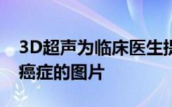 3D超声为临床医生提供了更清晰的治疗妇科癌症的图片