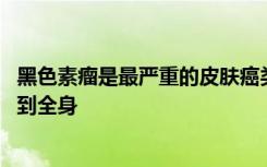 黑色素瘤是最严重的皮肤癌类型 它会侵入附近的组织并扩散到全身