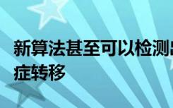 新算法甚至可以检测出整个淋巴瘤中最小的癌症转移