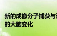 新的成像分子捕获与进行性多发性硬化症相关的大脑变化