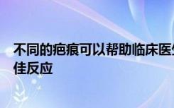 不同的疤痕可以帮助临床医生预测哪些患者对特定治疗的最佳反应