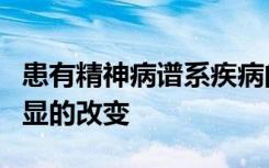 患有精神病谱系疾病的青年人大脑区域拥有明显的改变