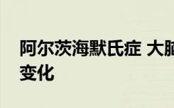 阿尔茨海默氏症 大脑如何在疾病过程中发生变化