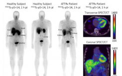 新型放射性示踪剂可产生心脏阿尔茨海默病的高质量图像