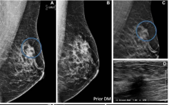十年研究表明断层合成技术可提高乳腺癌检测率